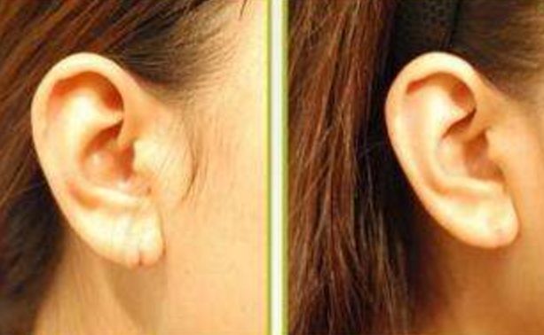 透明質(zhì)酸隆鼻揭秘：價(jià)格、特點(diǎn)、適用人群都在這！