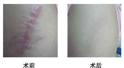 北京哪些醫(yī)院有出色的雙眼皮失敗修復(fù)效果？2023年口碑前十的整形醫(yī)院推薦！