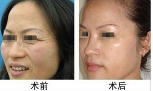 深圳藝星鼻子整形效果如何？文豐與?？溯x誰更擅長肋骨鼻綜合？