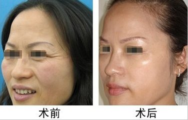 2023年南京自體脂肪注射臉頰哪家好？南京自體脂肪豐臉頰醫(yī)院排名前十，口碑揭秘！