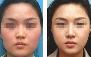 銘妍莊璐吸脂師：突出實(shí)力，匠心整形更美！