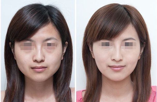 超聲刀與射頻：哪個(gè)更適合不同部位的治療？
