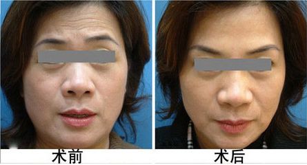 蘇州戴三友雙眼皮割好嗎？專家評價帶你了解科室實力！