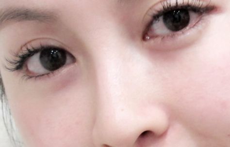 廈門市有多家豐臥蠶醫(yī)院？現(xiàn)在很受歡迎的廈門市中醫(yī)院盧藝樸專精于眼部整形手術