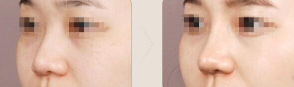 廈門腰腹吸脂整形醫(yī)院排行榜：揭曉口碑和人氣俱佳的十大名院