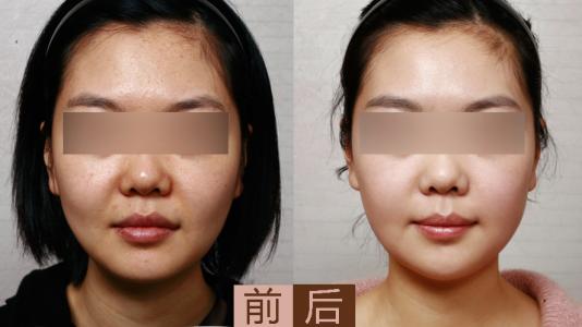 2023云南無針去眼袋整形10家無針美容醫(yī)院排名及口碑！