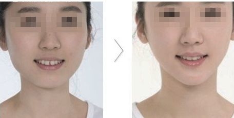 九江十大蘋果肌玻尿酸整形醫(yī)院推薦