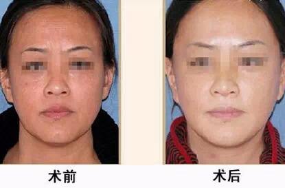 無錫哪家整形美容醫(yī)院的激光治療靜態(tài)紋技術(shù)比較好？2023年無錫治療靜態(tài)紋醫(yī)院口碑排行榜前10強(qiáng)實(shí)力盤點(diǎn)！
