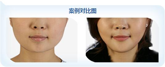 沈陽(yáng)內(nèi)窺鏡吸脂瘦腿療效出眾，2023年治療效果比較好的醫(yī)院排行榜發(fā)布！內(nèi)窺鏡吸脂瘦腿達(dá)到事半功倍效果！
