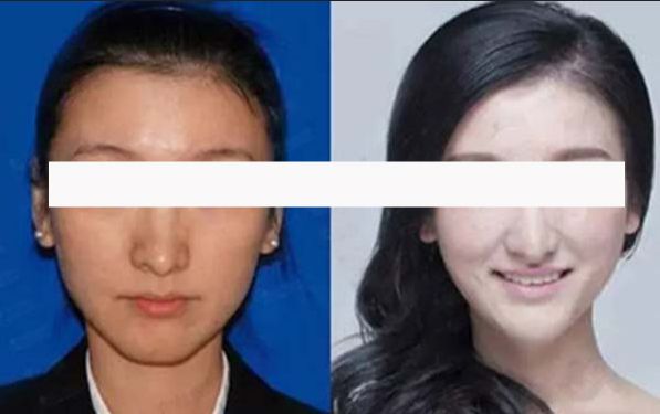 美眼成形術讓你選擇合適的眼部手術，完美解答如何選擇適合自己的眼部整形！