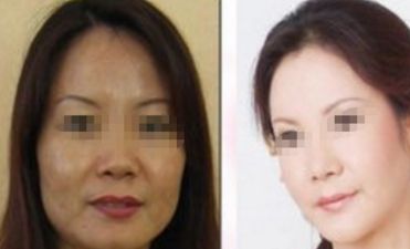 顴骨高、顴骨凸：感受及整形手術(shù)解析
