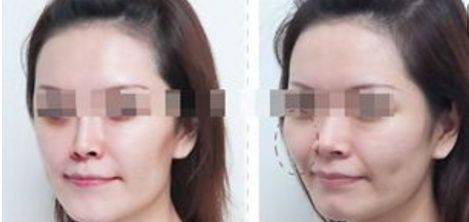 揭密涪陵和美婦產(chǎn)整形科：割雙眼皮、隆鼻技術(shù)親測評測