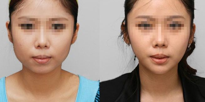 深圳眼角修復(fù)有哪些醫(yī)院？深圳美萊匯集經(jīng)驗豐富專業(yè)團(tuán)隊