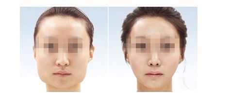2023年，婁底哪家醫(yī)院鼻基底膨體填充整形效果最棒？前十家醫(yī)療機(jī)構(gòu)實(shí)力評(píng)析！