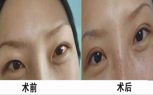 比較好的廣州外眼角懸吊術(shù)整形醫(yī)院排行榜前十強(qiáng)發(fā)布！2023年廣州外眼角懸吊術(shù)專業(yè)醫(yī)療機(jī)構(gòu)榮獲突出實(shí)力！