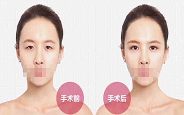 東莞FUP微創(chuàng)多點(diǎn)面部提升術(shù)：哪家醫(yī)院效果佳？2023年東莞FUP微創(chuàng)多點(diǎn)面部提升術(shù)醫(yī)院排行榜前十強(qiáng)享有認(rèn)證醫(yī)