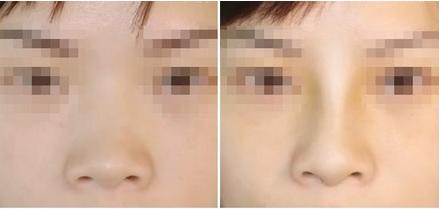 江蘇自體脂肪填充眉弓整形醫(yī)院哪家性價比超高？2023江蘇自體脂肪填充眉弓正規(guī)整形醫(yī)院排行推薦收藏！