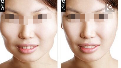 東莞哪家醫(yī)院做眼袋好？推薦華美、天后醫(yī)院更不容錯(cuò)過！