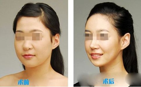 德寶麗法芮婭豐胸假體的型號(hào)、特點(diǎn)與價(jià)格指南