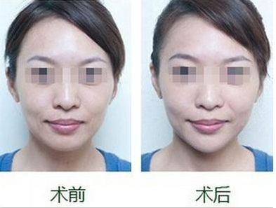 南海醫(yī)院整形美容科：抽脂手術成功案例分享