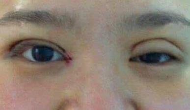 廣州懸吊式眼袋去除醫(yī)院口碑實測評
