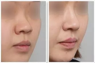 廈門鼻小柱整形醫(yī)院權(quán)威指南：10家口碑診所大起底