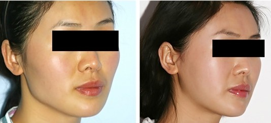 合肥哪家整形醫(yī)院眼袋祛除效果比較好？2023年排名前十的專業(yè)整容醫(yī)院
