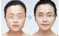 祛除眼袋手術(shù)不當(dāng)?shù)嫩E象與修補(bǔ)技巧解析