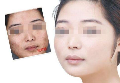 蘇州美貝爾假體豐胸真實價格及口碑：專家術(shù)前術(shù)后解析