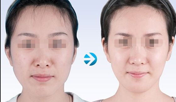 國內(nèi)哪家醫(yī)院的輪廓手術(shù)最專業(yè)？醫(yī)生大揭秘，含公、私立磨骨價格