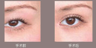 桐廬熊貓針眼袋填充推薦2023年口碑前十家整形醫(yī)院解析