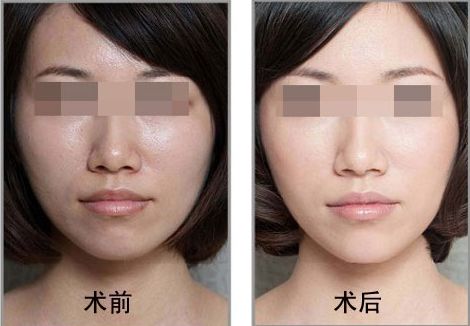 湘雅醫(yī)院祛疤攻略：掛號(hào)科室及疤痕修復(fù)案例詳解