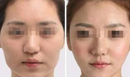 棗莊市立醫(yī)院整形科王廣寧激光去疤整容日記詳解