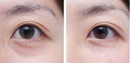 成都哪位醫(yī)生對(duì)吸脂效果好？美綻美整形何一波做抽脂怎么樣？