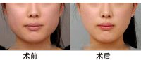 佳木斯瘦臉微整形醫(yī)院2023年排名前十入圍名單揭曉，哪家效果好？