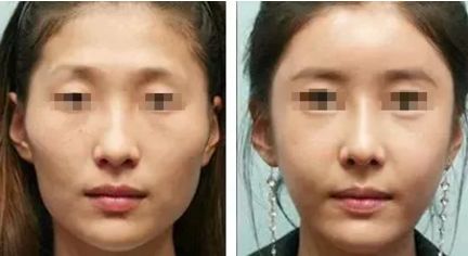 韓國整形失敗修復醫(yī)院推薦，普羅菲耳、THE醫(yī)院排名前列