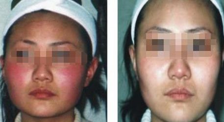 南京治療痘印疤痕的專業(yè)醫(yī)院排名