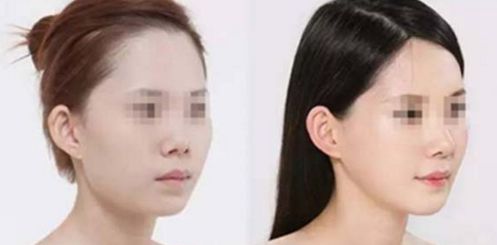 煙臺(tái)曙光整形：奧美定手術(shù)效果及患者口碑揭秘！