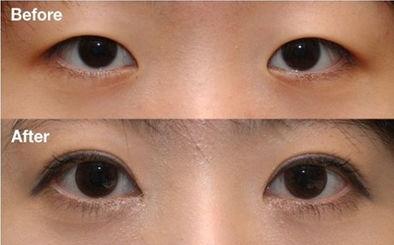 太原哪家醫(yī)院好被網(wǎng)友推薦的2023太原鼻唇溝填充生物劑整形醫(yī)院榜單!