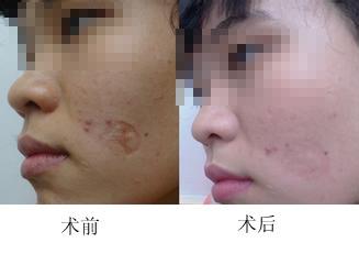 南京淚溝凹陷整形美容醫(yī)院推薦，哪家效果比較好？2023年南京淚溝凹陷整形醫(yī)院前10口碑榜揭曉