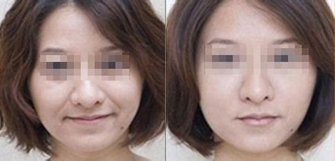 洛陽三院自體脂肪豐胸手術費用及口碑評價解析
