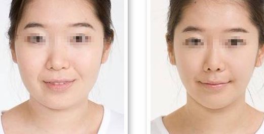 戰(zhàn)疤如何迅速消退？有效去除疤痕的妙招揭秘！