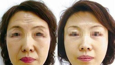 無(wú)錫哪家專業(yè)整形醫(yī)院去除抬頭紋效果好？2023年無(wú)錫去抬頭紋前十強(qiáng)醫(yī)院盤點(diǎn)揭秘！