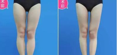 揭秘成都最受歡迎的脂肪填充醫(yī)院！知名醫(yī)療機(jī)構(gòu)紛紛上榜