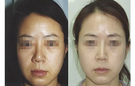 南京哪家生物軟骨隆鼻整形醫(yī)院好口碑反饋佳？2023年非常受歡迎的南京生物軟骨隆鼻整形美容醫(yī)院前10名排行全