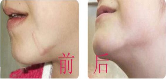 長(zhǎng)沙市哪家醫(yī)院在拉皮手術(shù)中技術(shù)扎實(shí)？最專業(yè)技術(shù)團(tuán)隊(duì)對(duì)比！