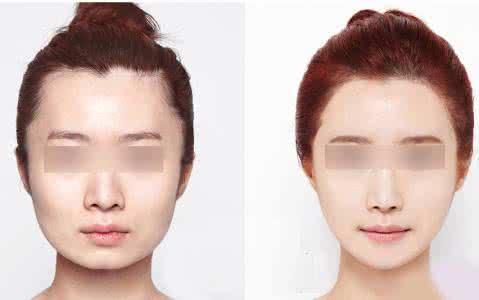 大連抬頭紋拉皮手術(shù)哪家醫(yī)院比較靠譜？