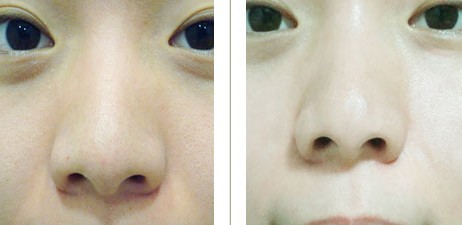 2023年北京哪家醫(yī)院技術(shù)好的眼袋填充細胞治療推薦