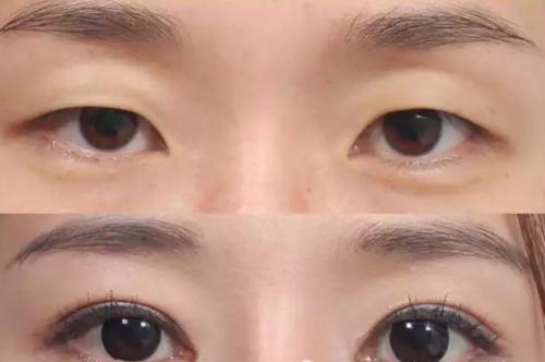 合肥微整形魚尾紋治療醫(yī)院排名揭曉！