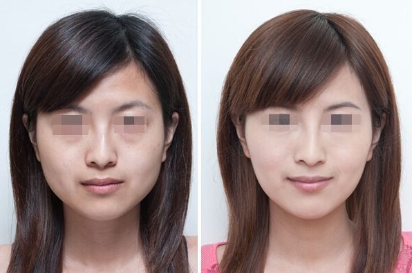 杭州瘦臉針美容診所即將推出超值優(yōu)惠，快來了解一下！